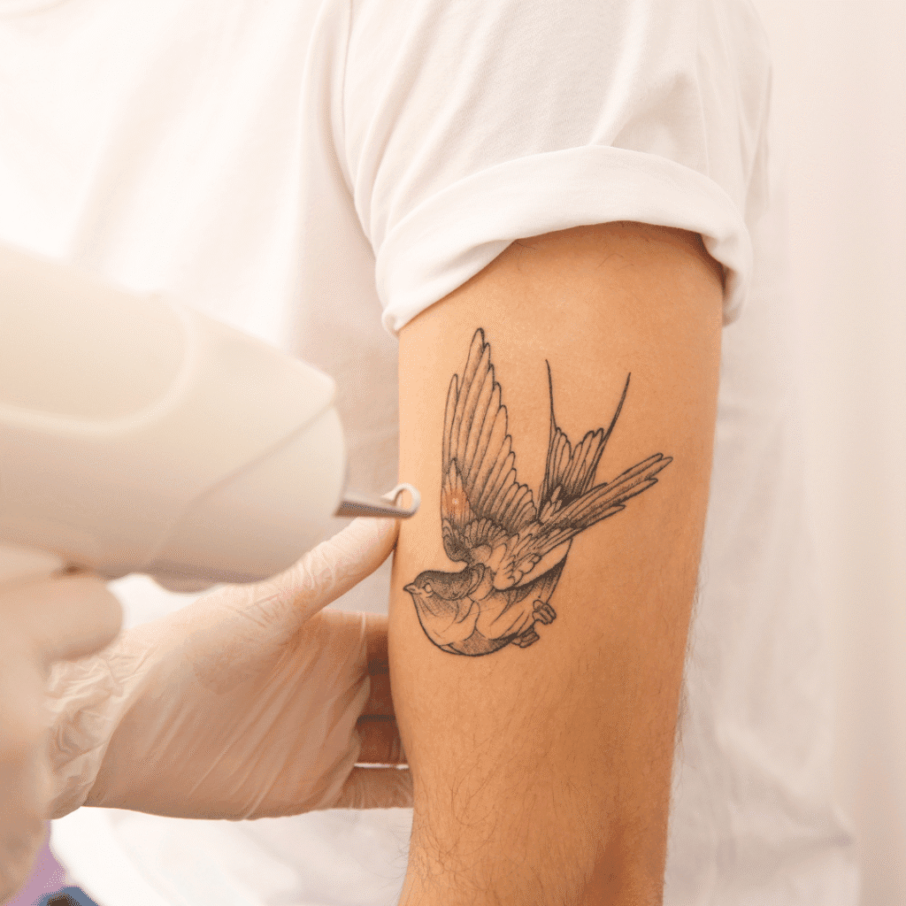 Προετοιμασία δέρματος πριν την αφαίρεση tatto με λέιζερ