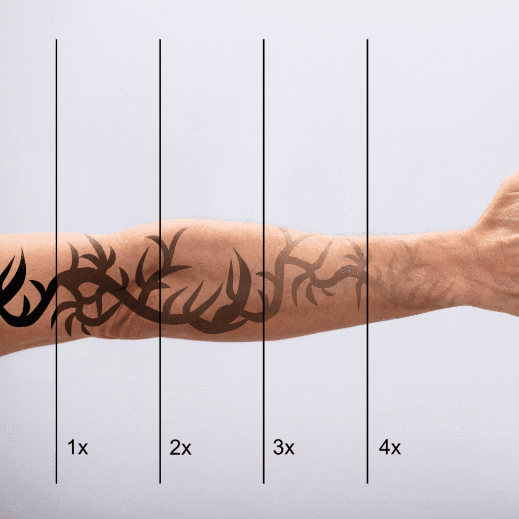 Σταδιακή αφαίρεση tatto από τον Δερματολόγο Δρ. Αριστείδη Μολυμπάκη